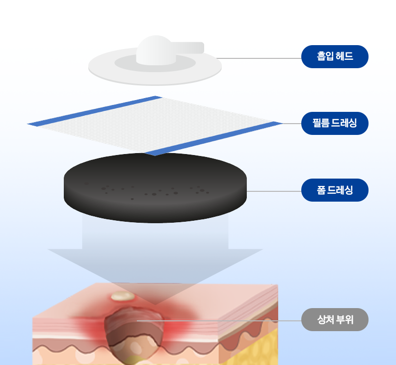 큐라백을 이용한 음압치료